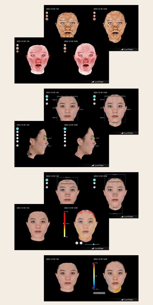 ヤーマン銀座店　フェイス・リフト・ジムの肌データ