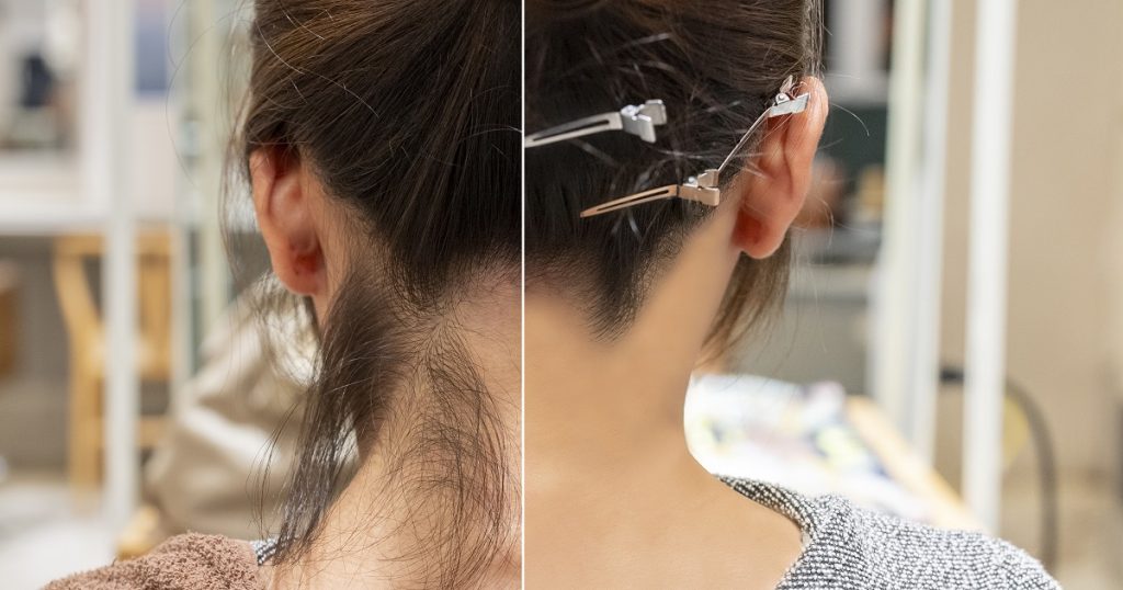 ネープケア、うなじ脱毛、襟足、生え際をすっきりデザイン、リサスティー、レミラ、REMILA、脱毛